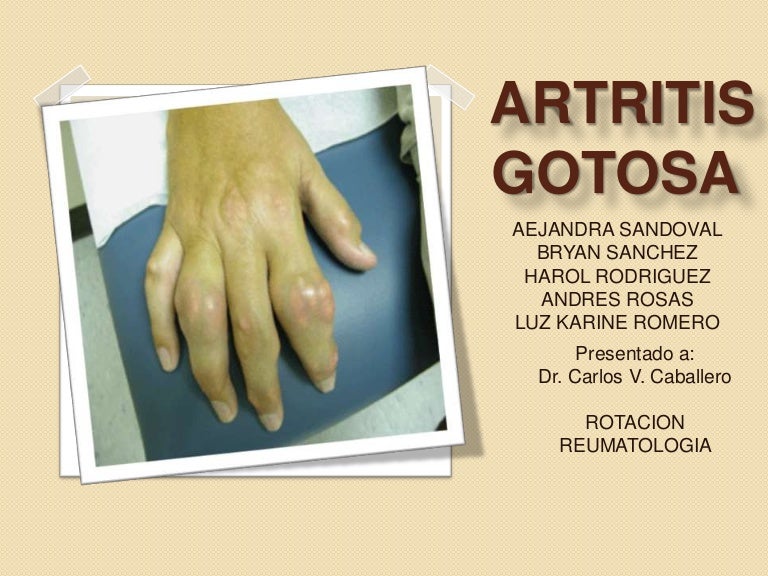 Artritis Gotosa Artritis Gotosa
