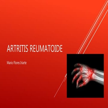 Artritis reumatoide