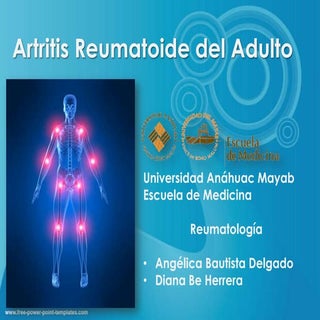 Artritis reumatoide del adulto.