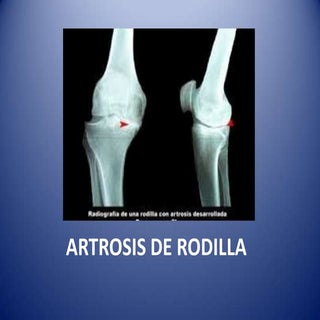 Artrosis de rodilla presentacion