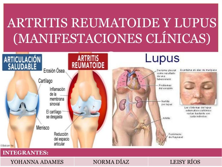 artritis TB eritematoso sistemico