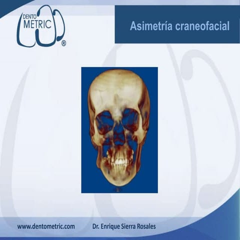 Asimetria facial