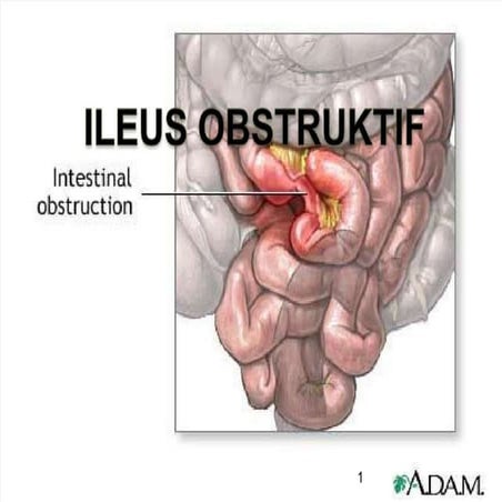 Ileus obstruktif | PPTX