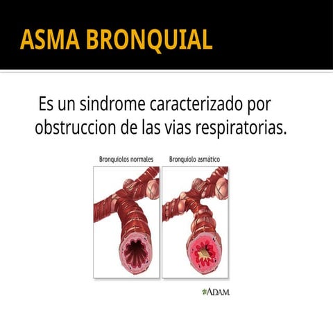 Asma bronquial.pptx