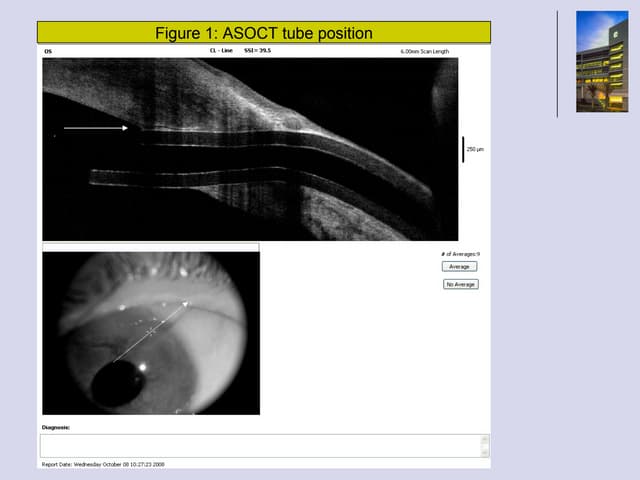 Asoct Tube Postion