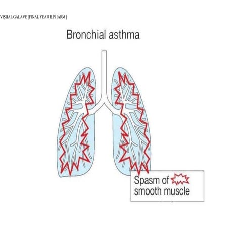 Asthma