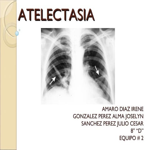 Atelectasia