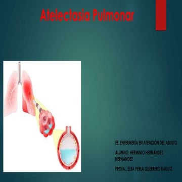 Atelectasia Pulmonar.pdf