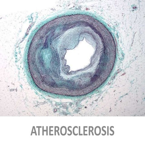 atherosclerosis.pptx