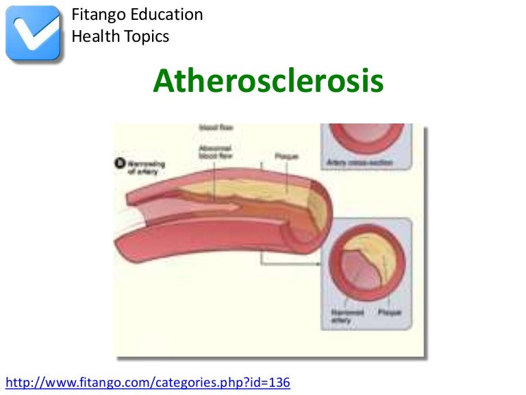 Atherosclerosis