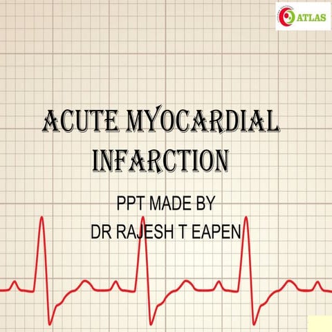 Atlas myocardialinfarction