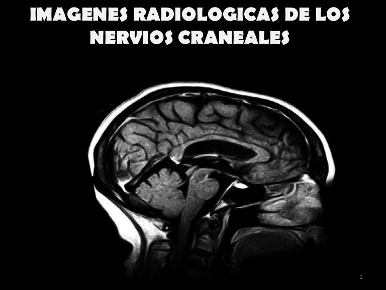 Atlas De Nervios Craneales Rm