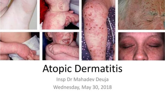 Dermatitis | PPT