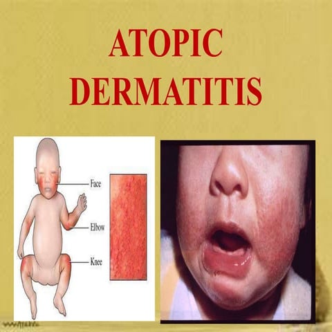 Atopic Dermatitis.pptx dermatitis skin inf | PPTX
