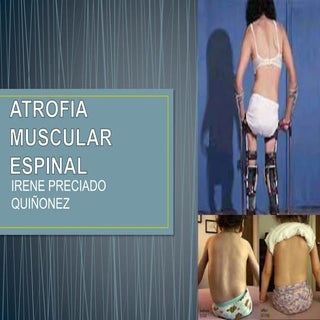 Atrofia muscular espinal