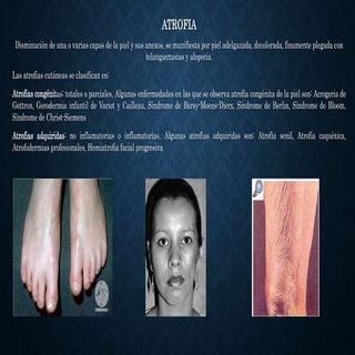 Atrofia