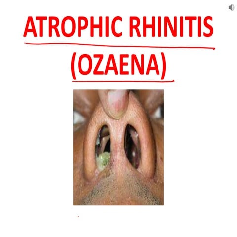 Atrophic rhinitis.pptx