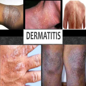 THERAPEUTICS OF DERMATITIS.BHMS.MATERIA MEDICA.HOMOEOPATHY