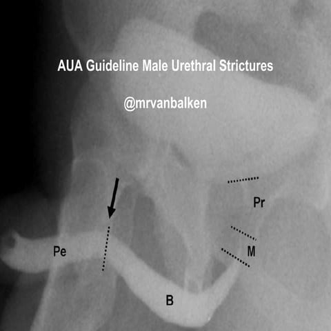 AUA Guideline Male Urethral Strictures