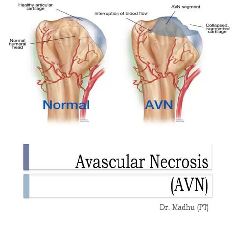 Avascular Necrosis (AVN).pptx................