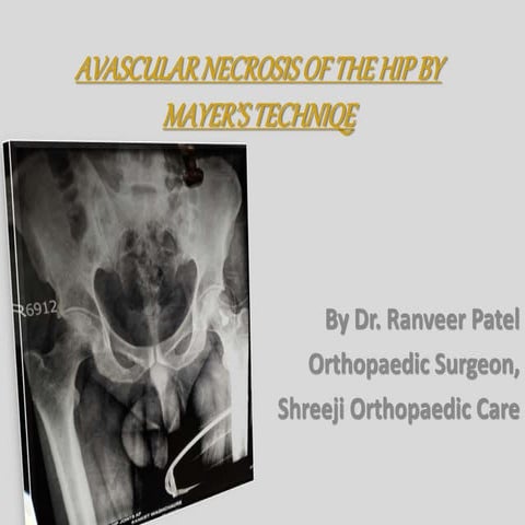 MEYER'S Procedure treatment for Avascular necrosis of femur head 