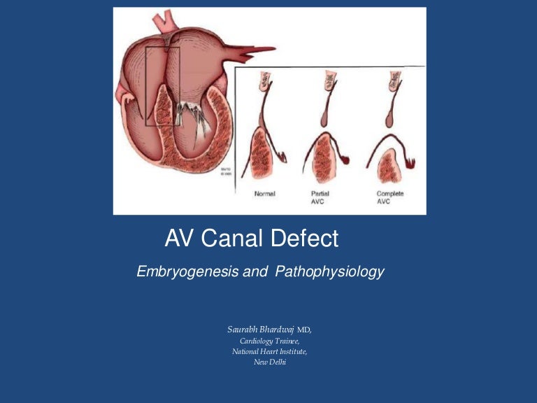 Av canal defect