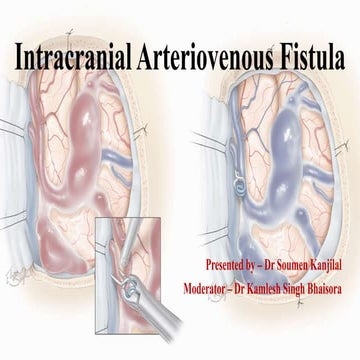Caroticocavernous fistula CCF | PPTX