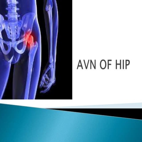 Avascular necrosis of femur