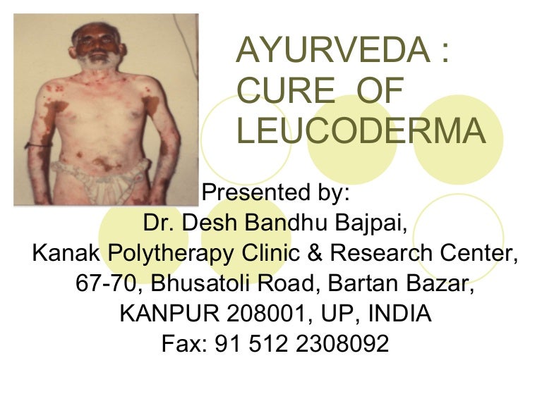 Ayurveda Cure Of Leucoderma
