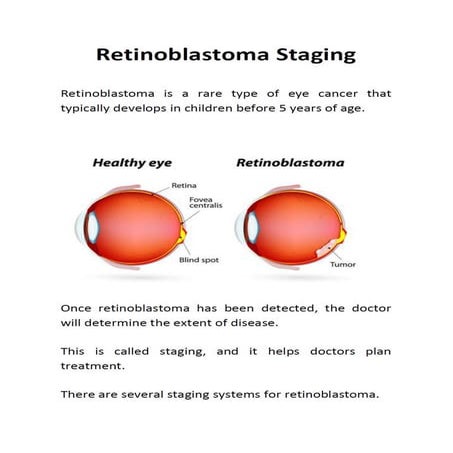 Retinoblastoma Staging | PDF