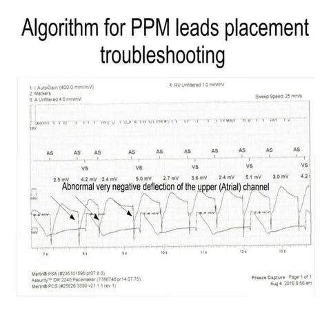 PPM RA lead troubleshooting | ODP