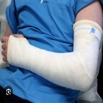 Backslap ZZ Sibisi.pptx Plaster of peris