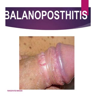 Balanoposthitis