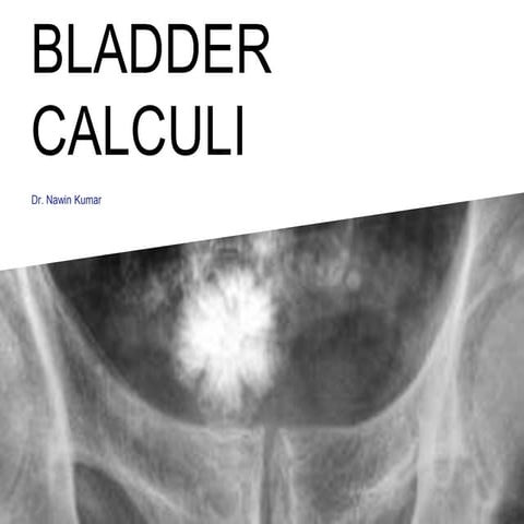 Baldder calculi neo