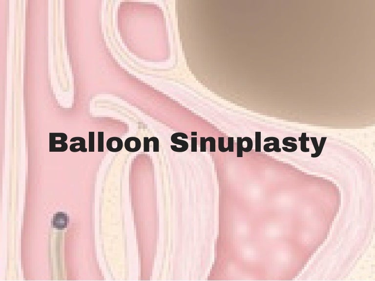 Balloon Sinuplasty in Houston