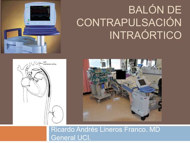 Balon de contrapulsación