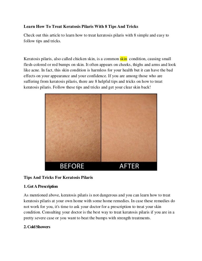 Learn How To Treat Keratosis Pilaris With 8 Tips And Tricks