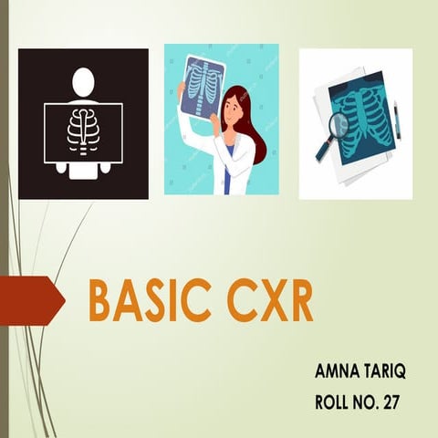 Understanding and Reading of Chest X-Rays | PPTX