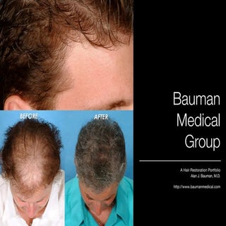 Hair Transplant Results including m...