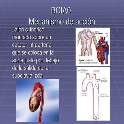 Balón contrapulsavion intraop Yoco powerpoint | PPT