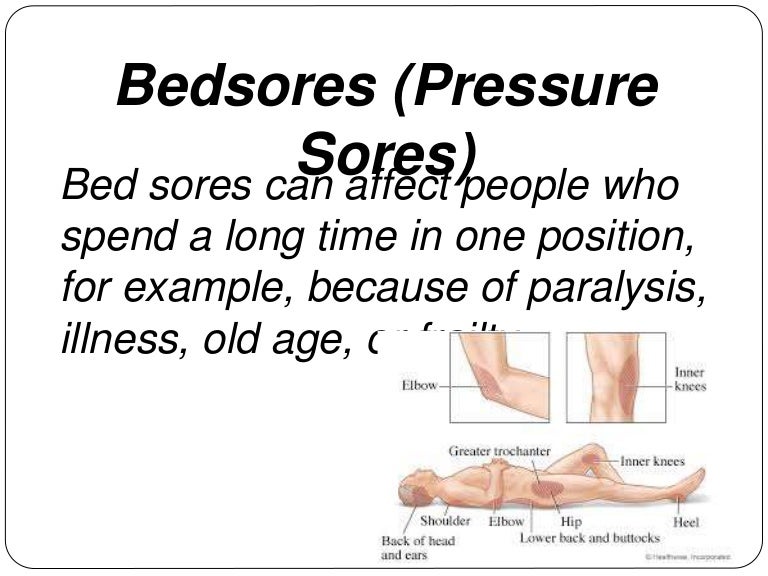 Bedsores Prevention Treatment, Causes, Diagnosis
