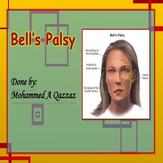 Bell's palsy