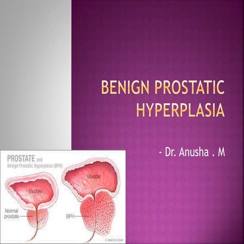 Benign prostatic hyperplasia