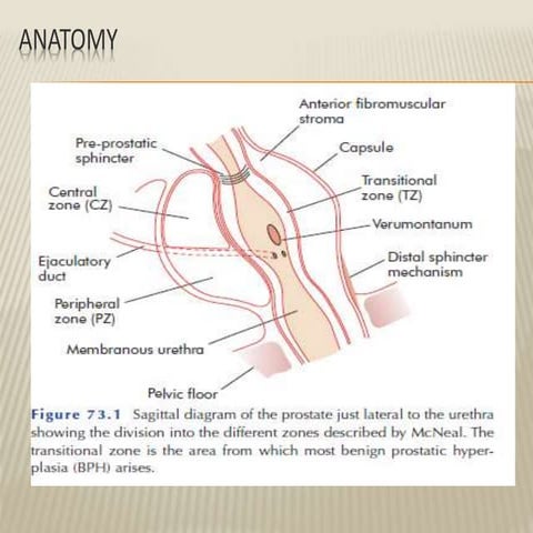 Benign prostatic hyperplasia