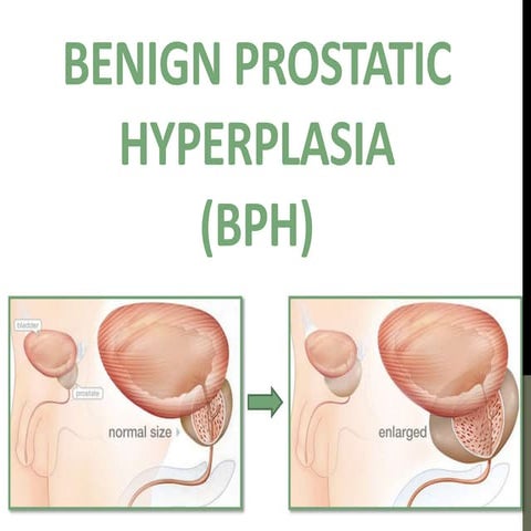 Benign prostatic hyperplasia - symptomes and treatment
