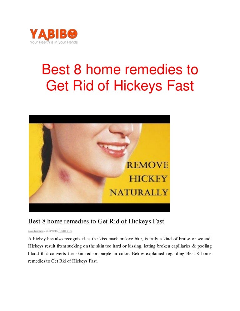 Best 8 home remedies to get rid of hickeys fastpdf