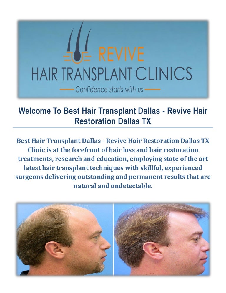 Best Hair Transplant Dallas Revive Hair Restoration in Dallas