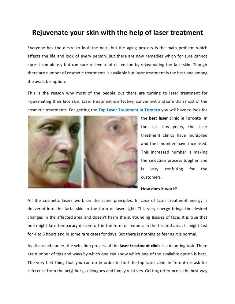 Best laser clinic_in_toronto