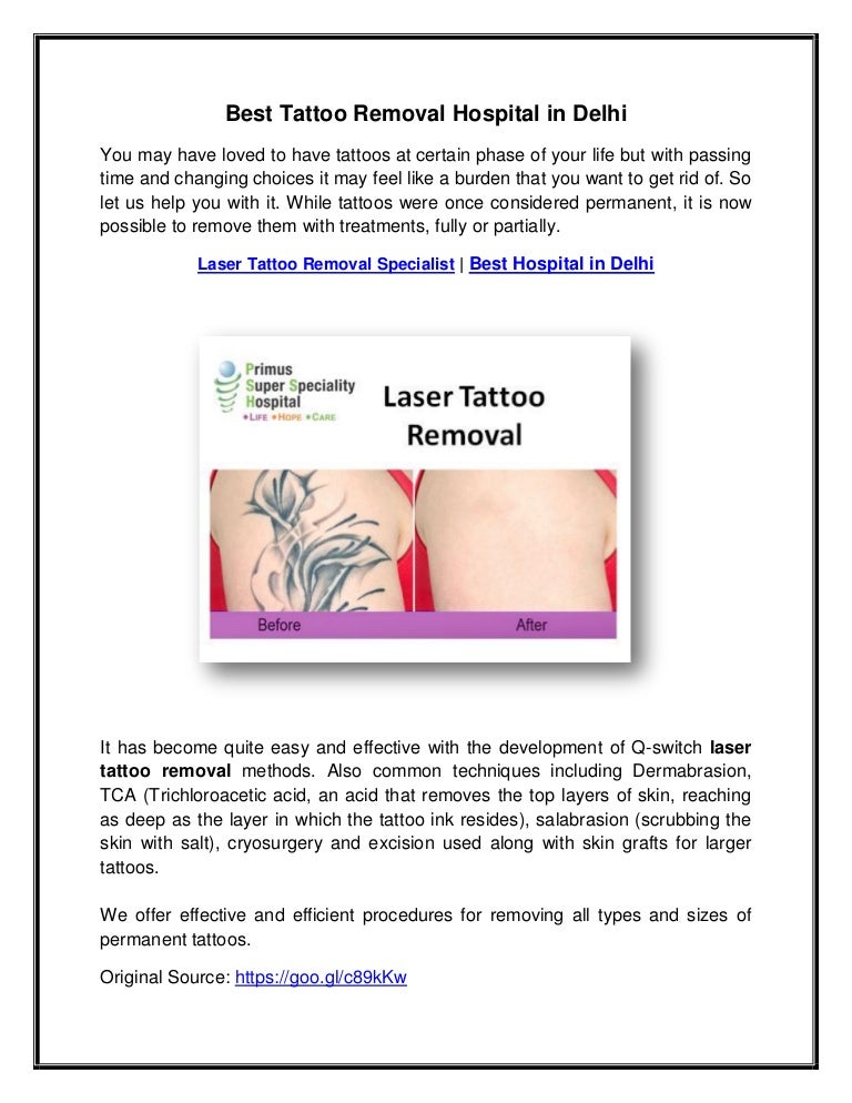 best tattoo removal hospital in delhi best tattoo removal hospital in delhi