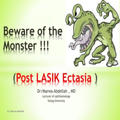 Beware of the monster; postlasik ectasia | PPTX